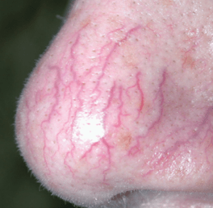 nose capillaries