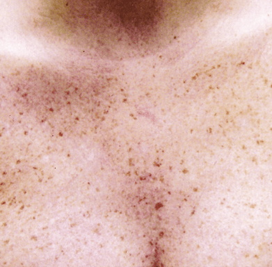 chest pigmentation