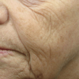 face wrinkles